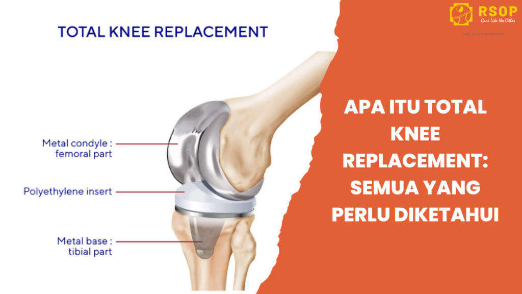 Apa-Itu-Total-Knee-Replacement