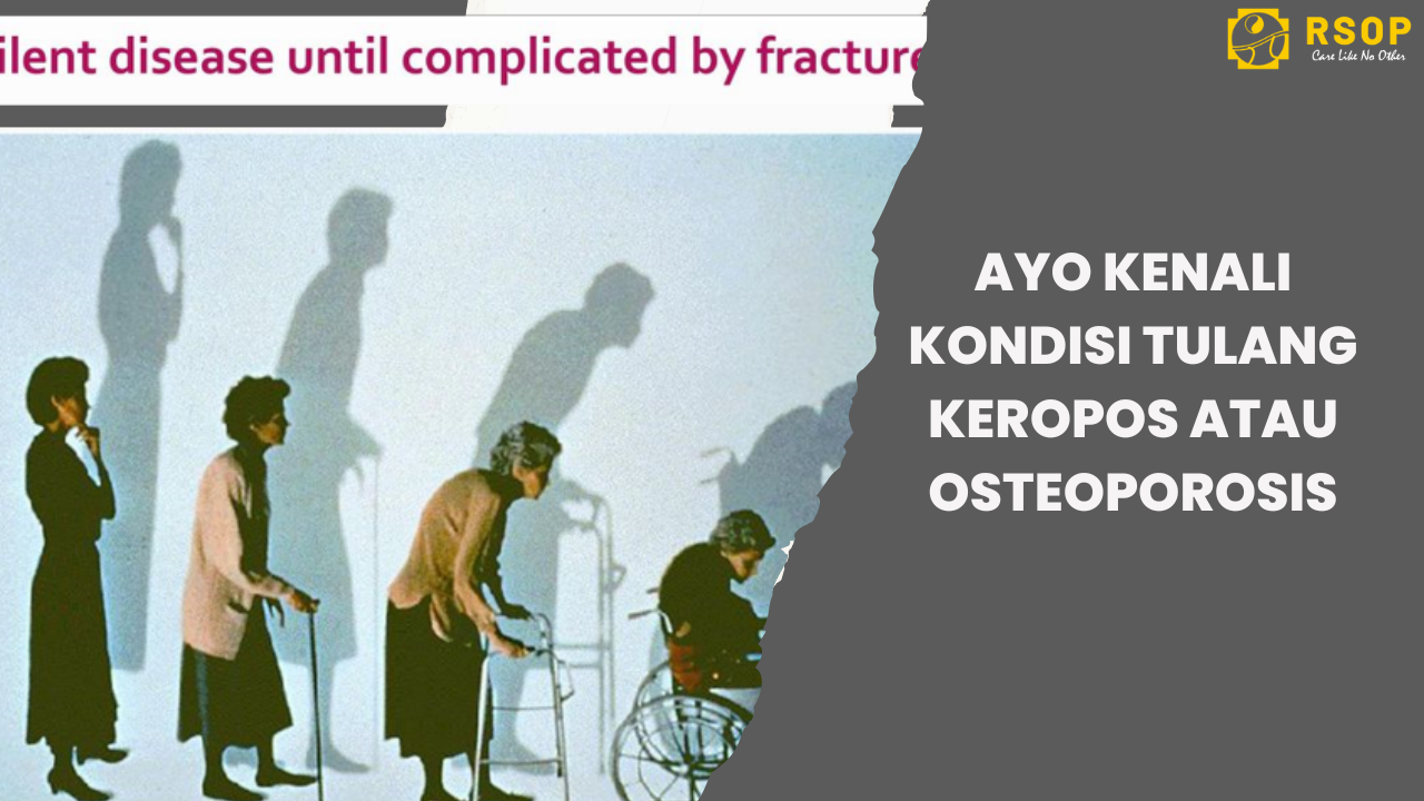Ayo Kenali Kondisi Tulang Keropos atau Osteoporosis