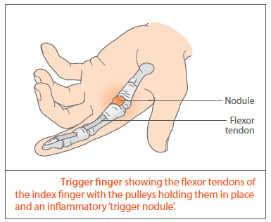 Definisi Trigger Finger