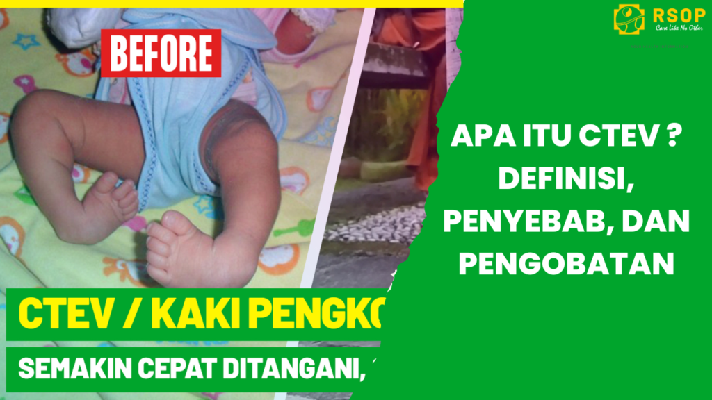 KAKI PENGKOR PADA BAYI (CTEV), JANGAN PESIMIS