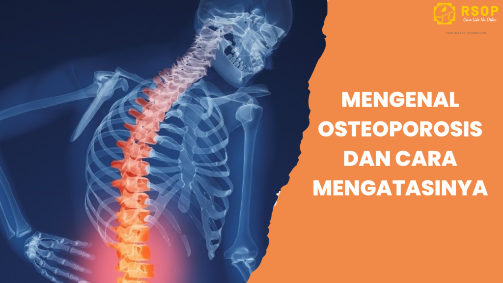 Mengenal Osteoporosis: Mencegah dan Cara Mengatasinya