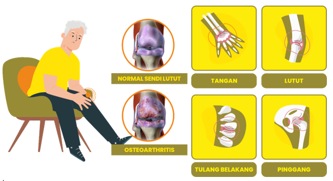 apa itu ostoarthitis