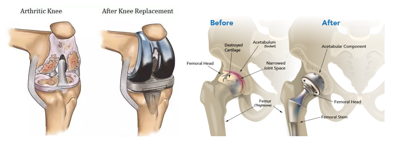 operasi osteoarthitis