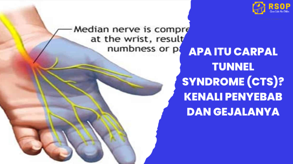 Apa Itu Carpal Tunnel Syndrome (CTS)? Kenali Penyebab dan Gejalanya