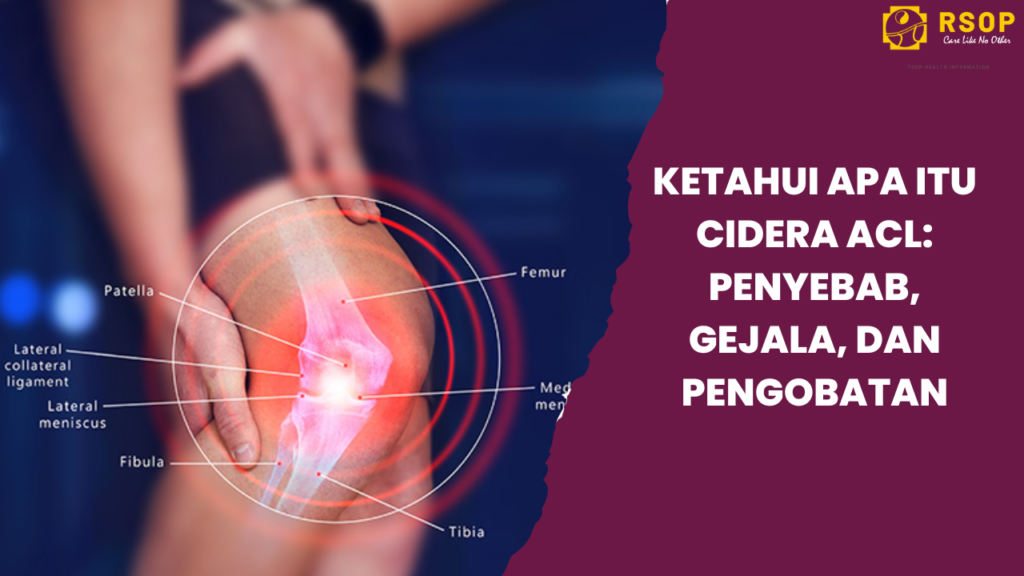 Ketahui Apa itu Cedera ACL: Penyebab, Gejala, dan Pengobatan