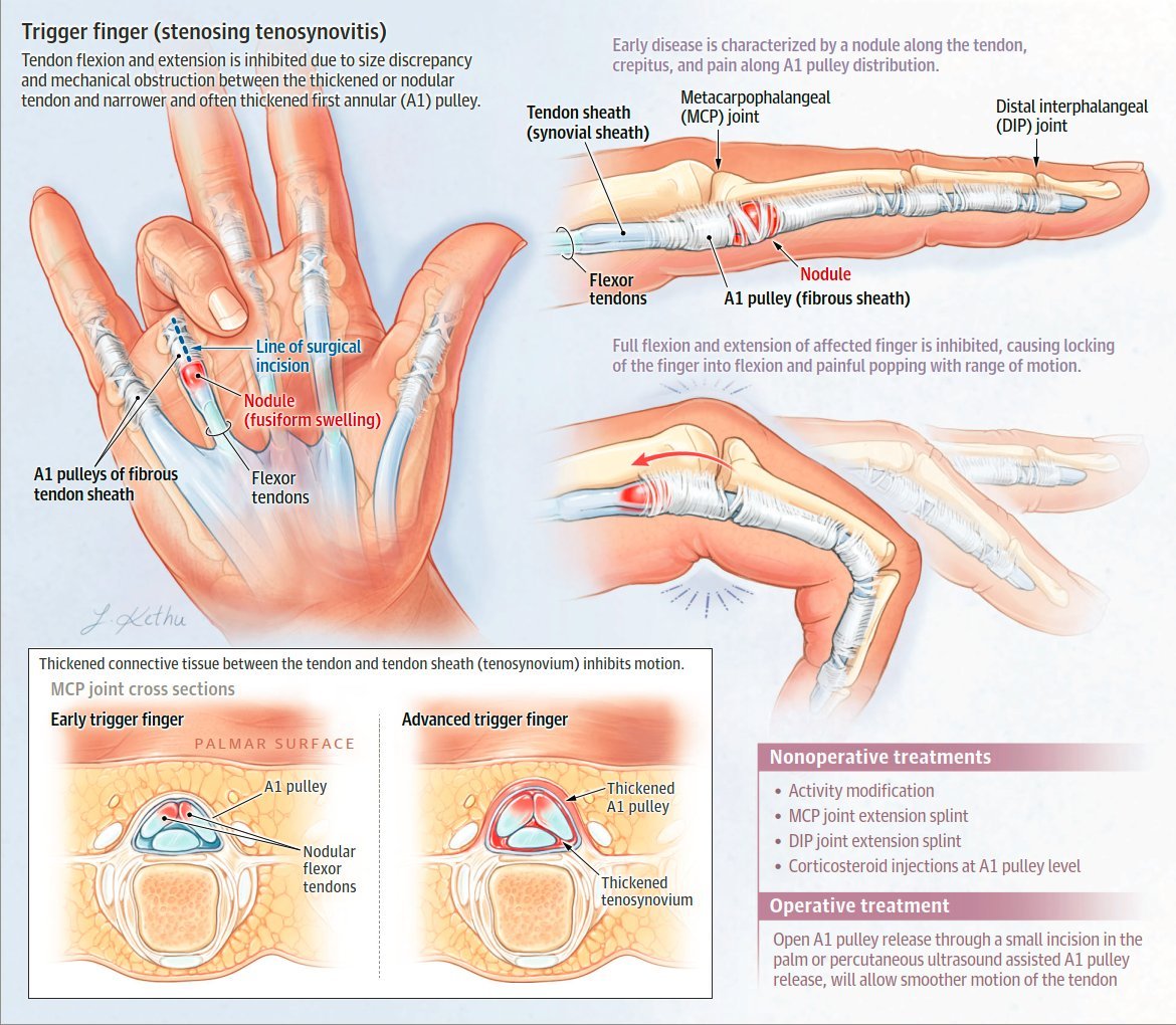 terjadinya trigger finger